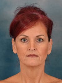 Laser Skin Resurfacing Before & After Gallery - Patient 405803 - Image 1