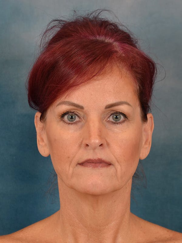 Laser Skin Resurfacing Before & After Gallery - Patient 405803 - Image 1