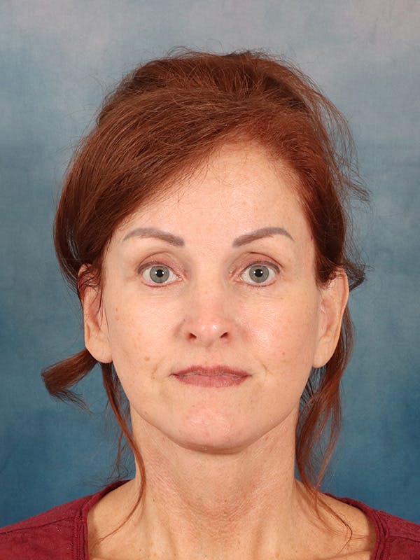 Laser Skin Resurfacing Before & After Gallery - Patient 405803 - Image 2