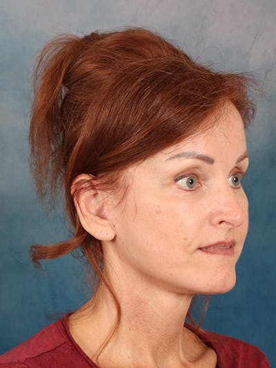Laser Skin Resurfacing Before & After Gallery - Patient 405803 - Image 8