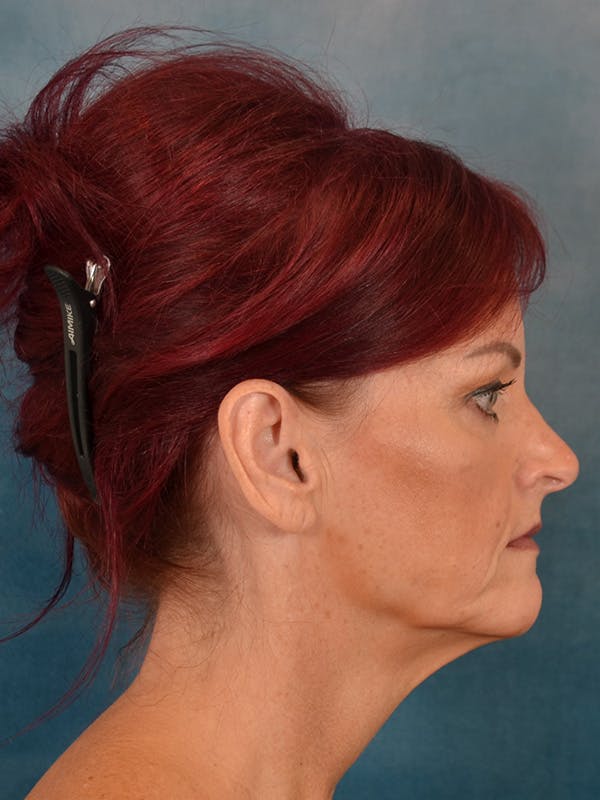 Laser Skin Resurfacing Before & After Gallery - Patient 405803 - Image 9