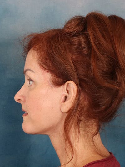 Laser Skin Resurfacing Before & After Gallery - Patient 405803 - Image 6