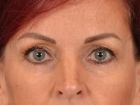 Eyelid Lift Before & After Gallery - Patient 293062 - Image 1