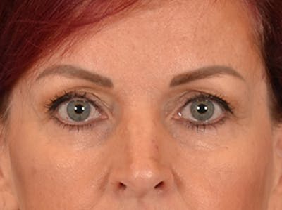 Eyelid Lift Before & After Gallery - Patient 293062 - Image 1