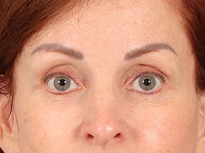 Eyelid Lift Before & After Gallery - Patient 293062 - Image 2