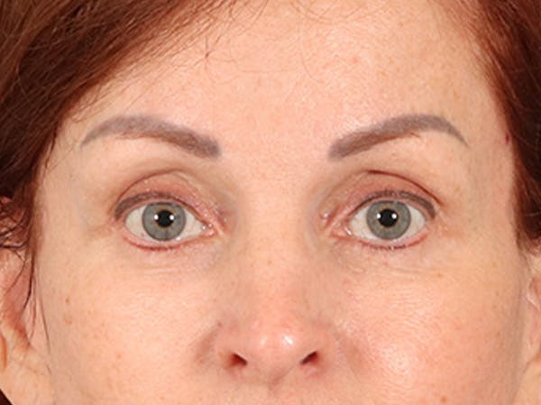 Eyelid Lift Before & After Gallery - Patient 293062 - Image 2
