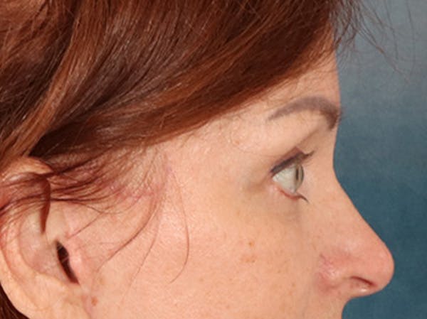 Eyelid Lift Before & After Gallery - Patient 293062 - Image 6