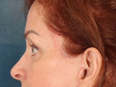 Eyelid Lift Before & After Gallery - Patient 293062 - Image 10