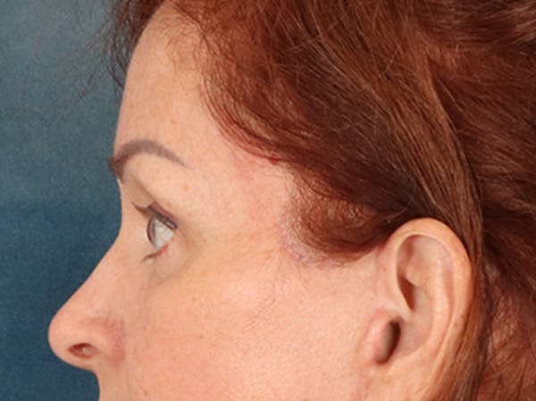 Eyelid Lift Before & After Gallery - Patient 293062 - Image 10