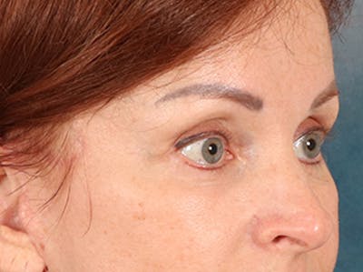 Eyelid Lift Before & After Gallery - Patient 293062 - Image 4