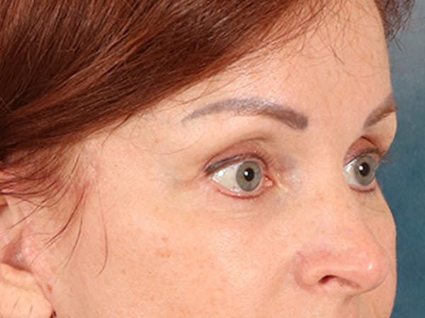 Eyelid Lift Before & After Gallery - Patient 293062 - Image 4