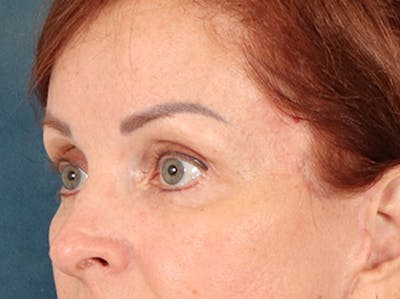 Eyelid Lift Before & After Gallery - Patient 293062 - Image 8