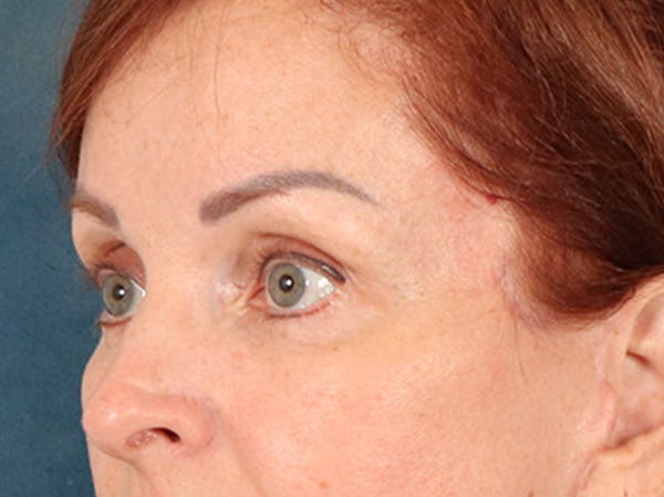 Eyelid Lift Before & After Gallery - Patient 293062 - Image 8