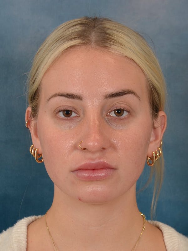 Rhinoplasty Before & After Gallery - Patient 838181 - Image 5