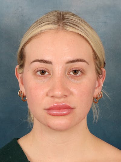 Rhinoplasty Before & After Gallery - Patient 838181 - Image 6