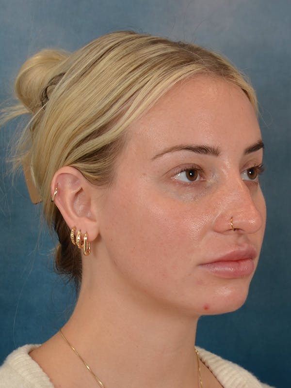 Rhinoplasty Before & After Gallery - Patient 838181 - Image 7