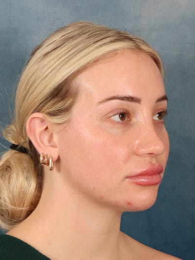 Rhinoplasty Before & After Gallery - Patient 838181 - Image 8