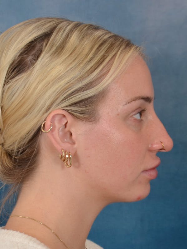 Rhinoplasty Before & After Gallery - Patient 838181 - Image 9