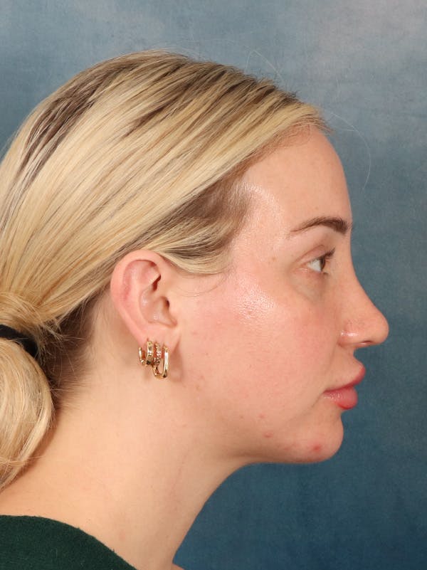 Rhinoplasty Before & After Gallery - Patient 838181 - Image 10