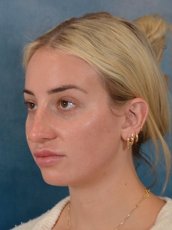 Rhinoplasty Before & After Gallery - Patient 838181 - Image 3