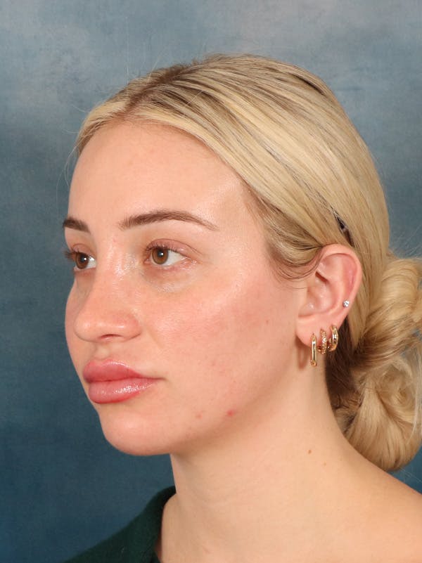Rhinoplasty Before & After Gallery - Patient 838181 - Image 4