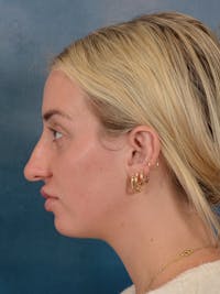 Rhinoplasty Before & After Gallery - Patient 838181 - Image 1