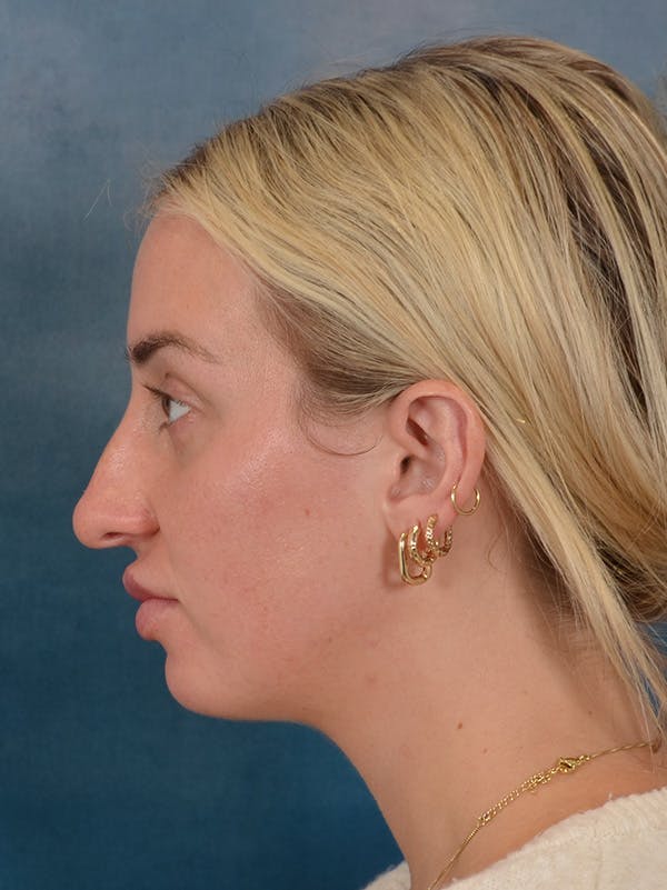Rhinoplasty Before & After Gallery - Patient 838181 - Image 1