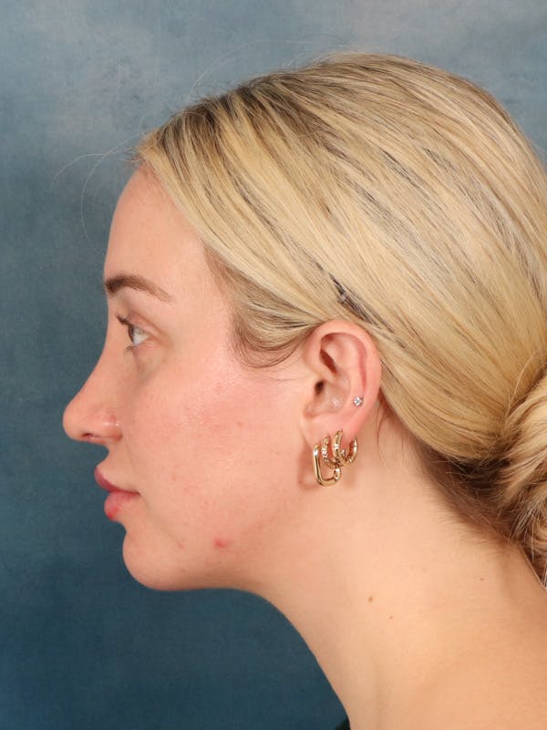 Rhinoplasty Before & After Gallery - Patient 838181 - Image 2