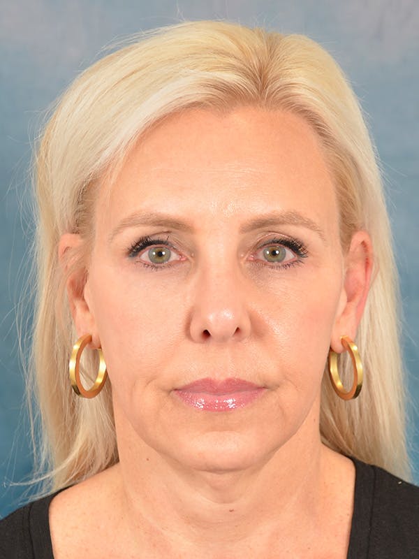 Brow Lift Before & After Gallery - Patient 372997 - Image 1