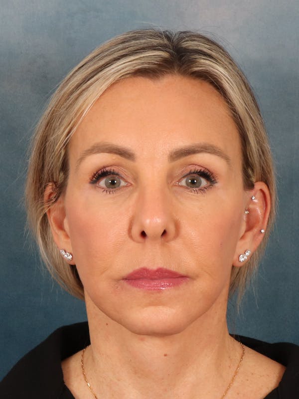 Brow Lift Before & After Gallery - Patient 372997 - Image 2