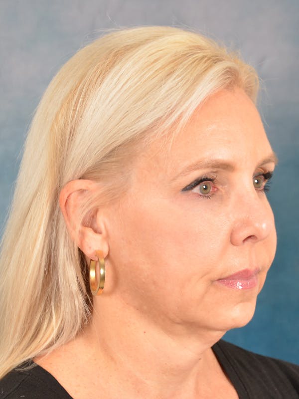 Brow Lift Before & After Gallery - Patient 372997 - Image 7