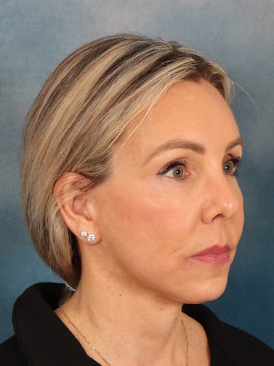 Brow Lift Before & After Gallery - Patient 372997 - Image 8