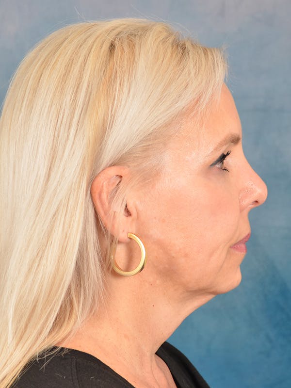 Brow Lift Before & After Gallery - Patient 372997 - Image 9