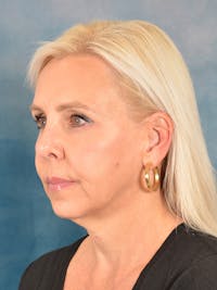 Deep Plane Facelift Before & After Gallery - Patient 148969 - Image 1