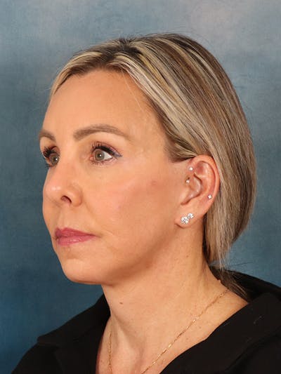 Brow Lift Before & After Gallery - Patient 372997 - Image 4