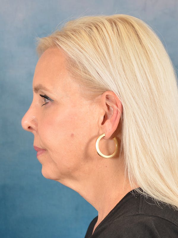 Brow Lift Before & After Gallery - Patient 372997 - Image 5