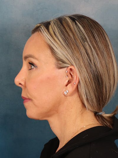 Brow Lift Before & After Gallery - Patient 372997 - Image 6