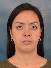 Deep Neck Lift Before & After Gallery - Patient 243028 - Image 1