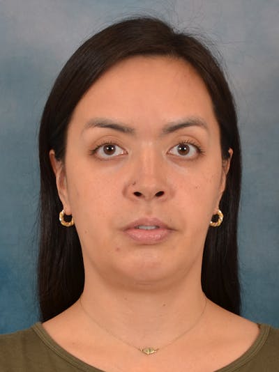 Deep Neck Lift Before & After Gallery - Patient 243028 - Image 1