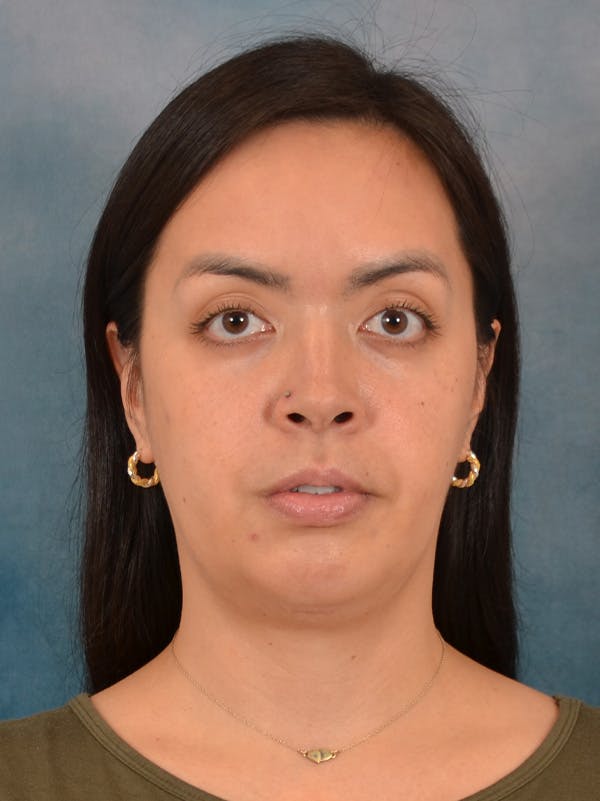 Deep Neck Lift Before & After Gallery - Patient 243028 - Image 1