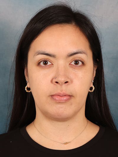 Deep Neck Lift Before & After Gallery - Patient 243028 - Image 2