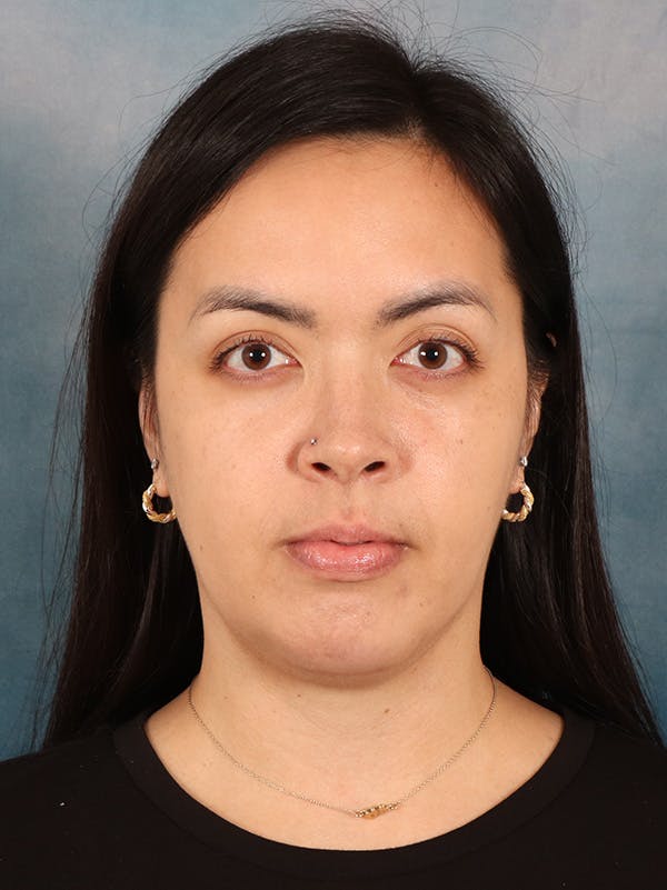 Deep Neck Lift Before & After Gallery - Patient 243028 - Image 2