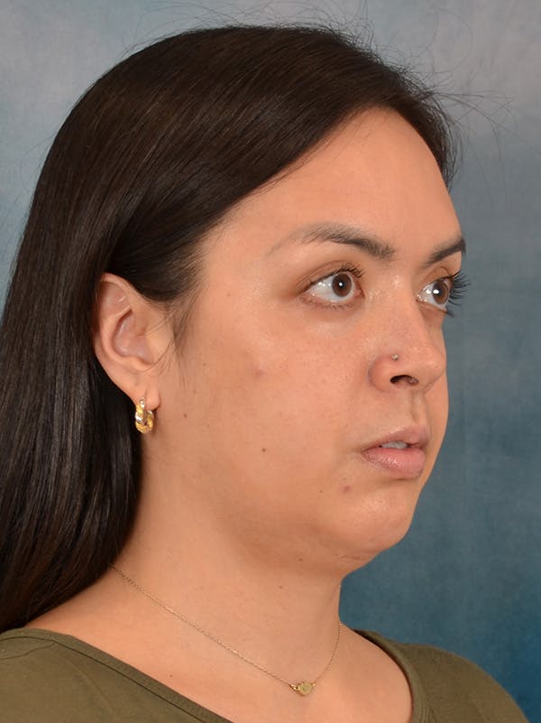 Deep Neck Lift Before & After Gallery - Patient 243028 - Image 3