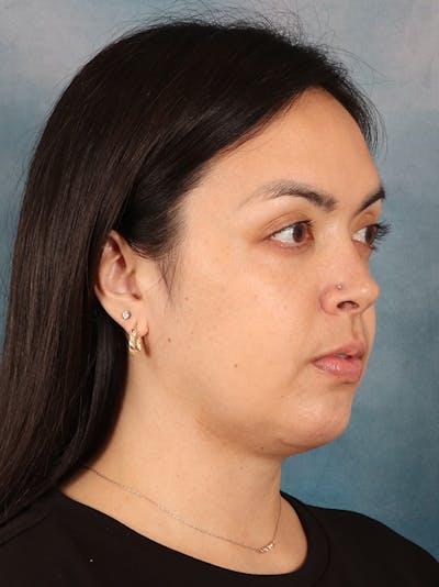 Deep Neck Lift Before & After Gallery - Patient 243028 - Image 4