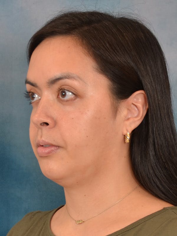 Deep Neck Lift Before & After Gallery - Patient 243028 - Image 7