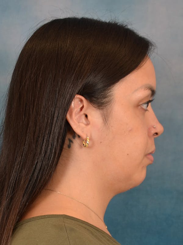 Deep Neck Lift Before & After Gallery - Patient 243028 - Image 5