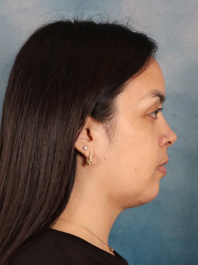 Deep Neck Lift Before & After Gallery - Patient 243028 - Image 6