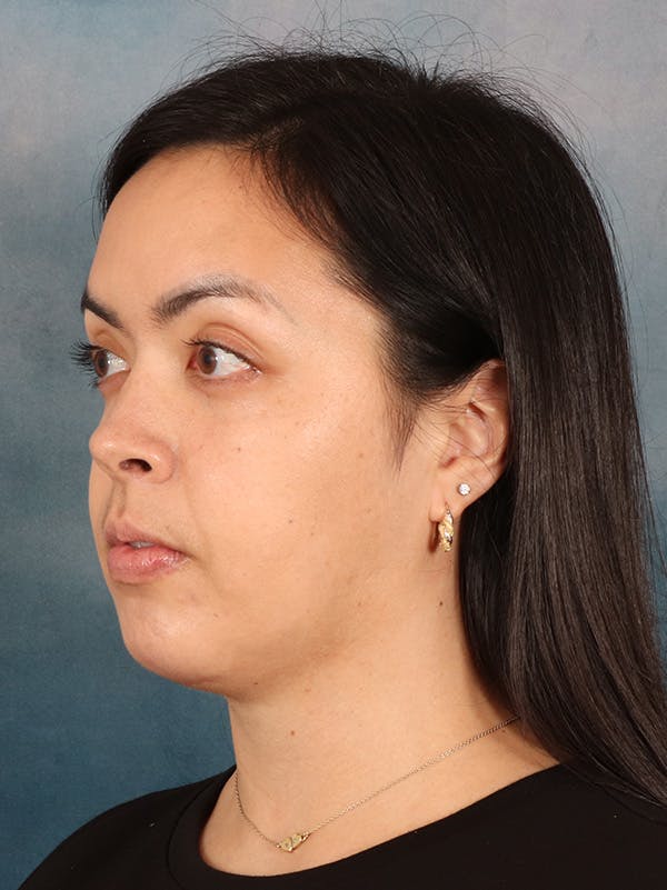 Deep Neck Lift Before & After Gallery - Patient 243028 - Image 8