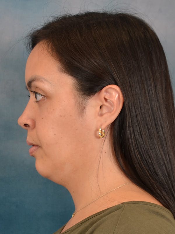 Deep Neck Lift Before & After Gallery - Patient 243028 - Image 9