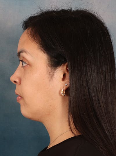 Deep Neck Lift Before & After Gallery - Patient 243028 - Image 10